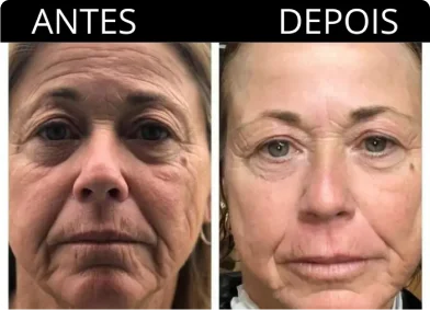 antes e depois beauty glow max