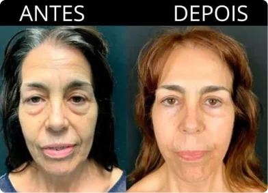 antes e depois beauty-glow-max